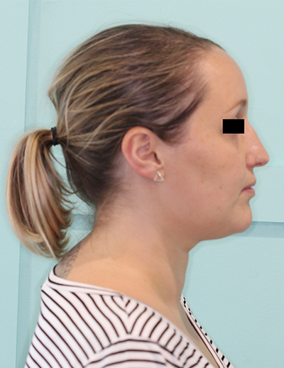 TMJ Treatment Kawana, Sunshine Coast