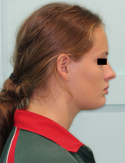 TMJ Treatment Kawana, Sunshine Coast