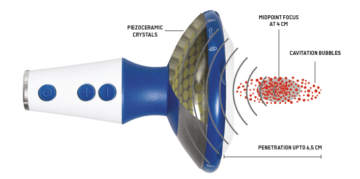 Focused shockwave therapy handpiece delivering acoustic waves to tissue
